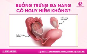 Buồng Trứng Đa Nang Có Nguy Hiểm Không